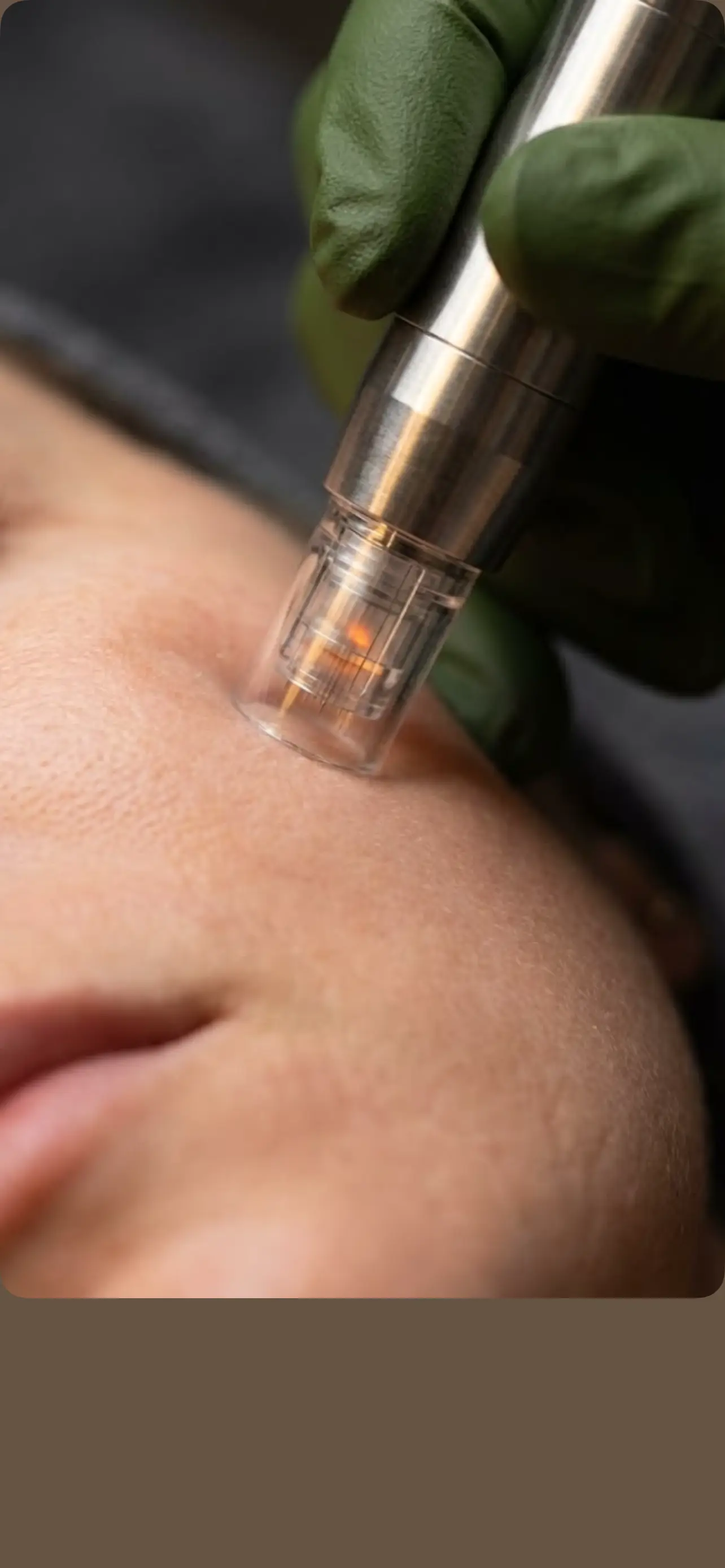 Microneedling